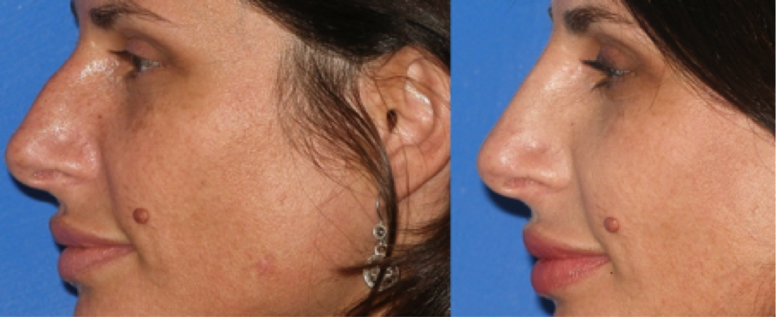 Non-surgical Nose Job Before and After