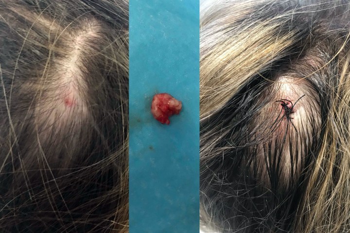 before and after pilar cyst