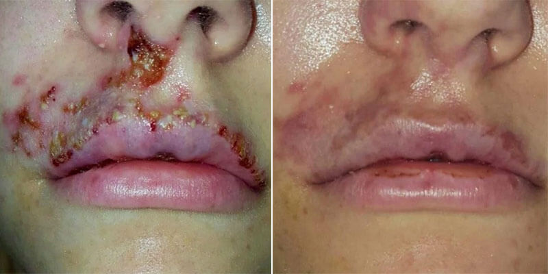 Botched lip fillers