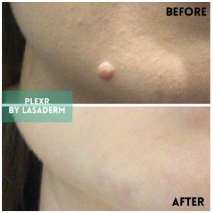 jawline mole removal