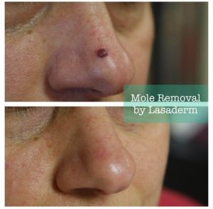 lasaderm small mole removal