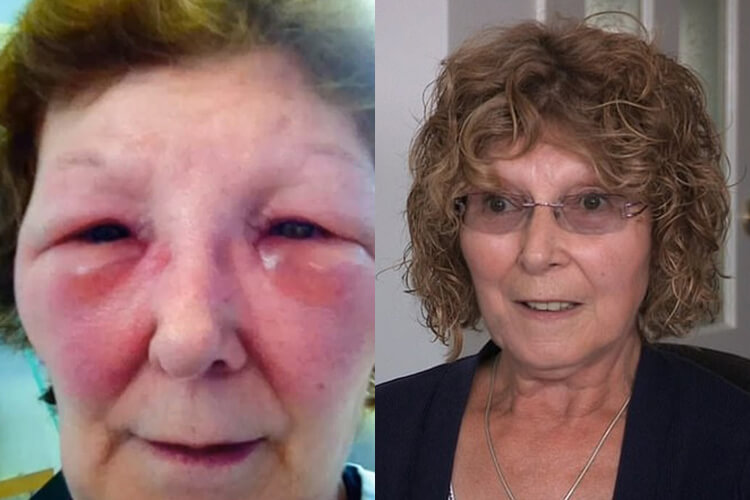 mrs king before and after botched botox