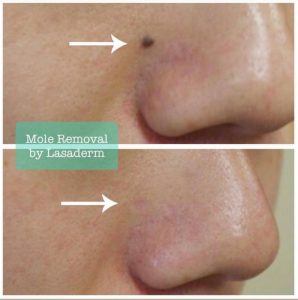 nose mole removal lasaderm