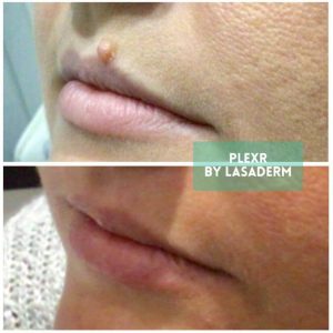 top lip mole removal