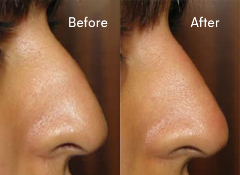 Non-surgical Nose Job Before and After