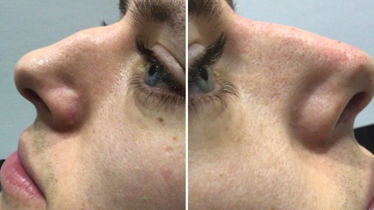 nose job before and after