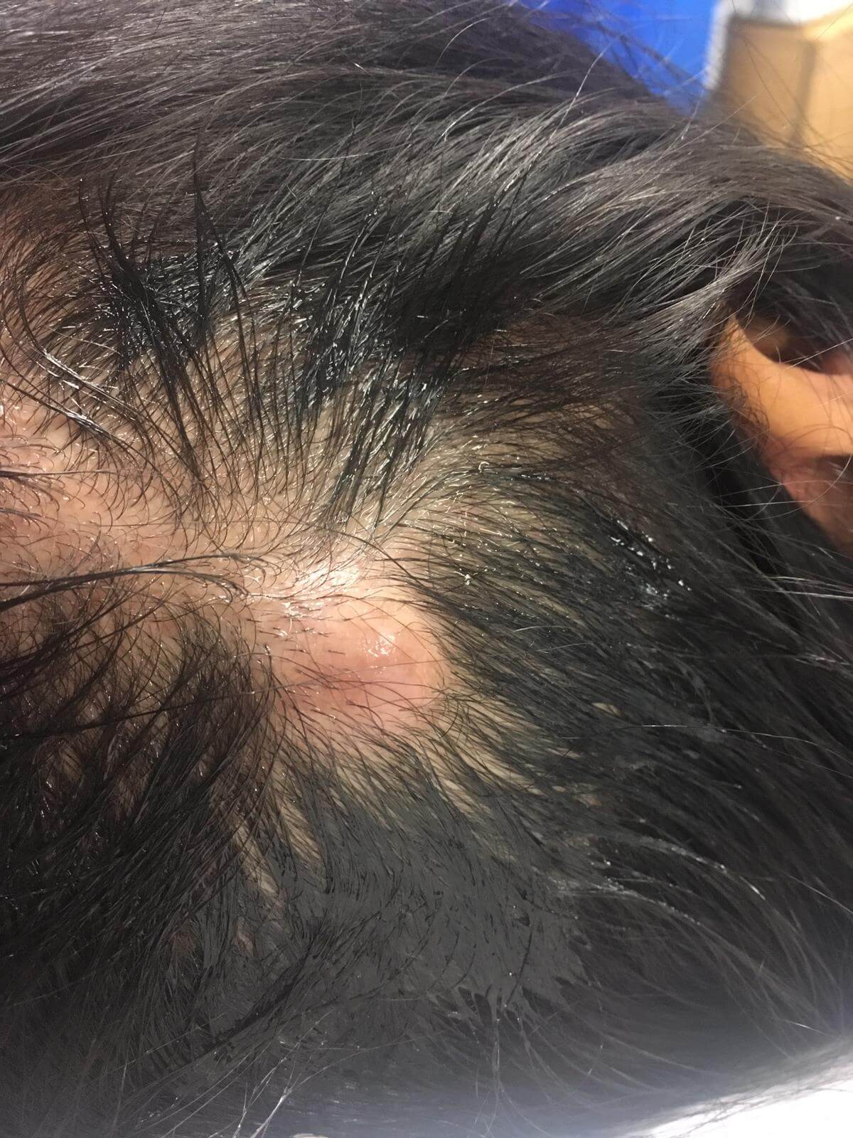 Blackhead Cyst Removal Video - imtr7ip