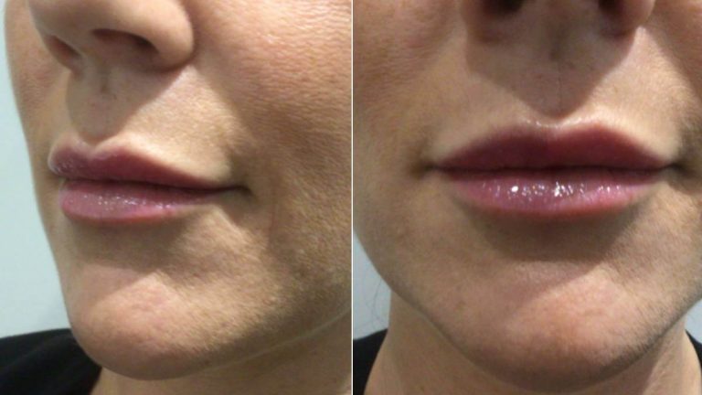 Lip Filler Case Study