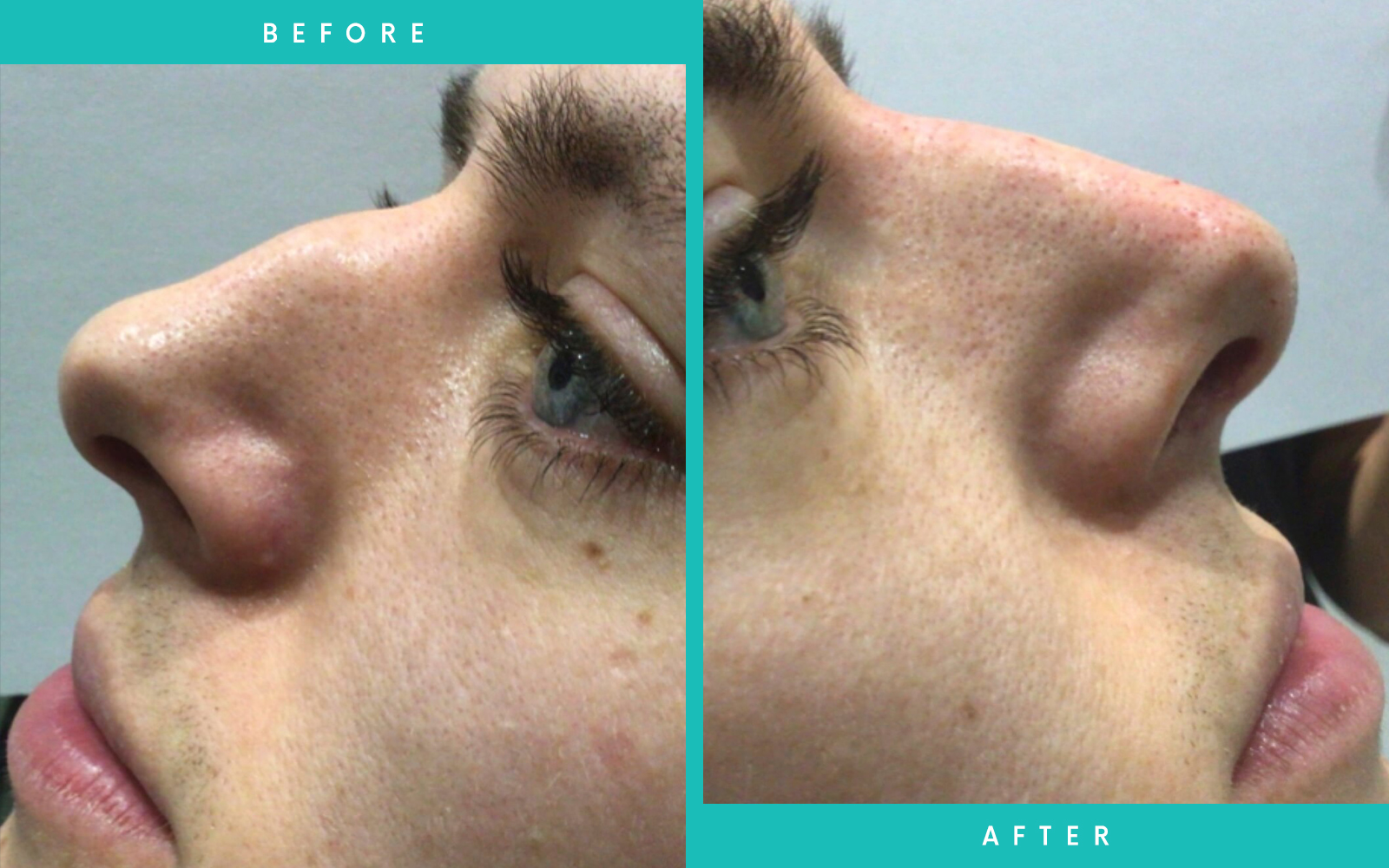 Before and After Nose filler