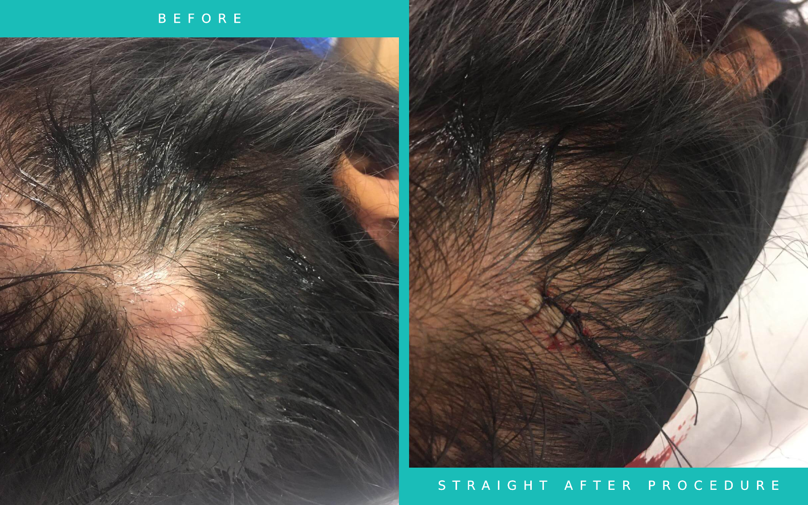 Erika's Cyst Removal Success Story LasaDerm
