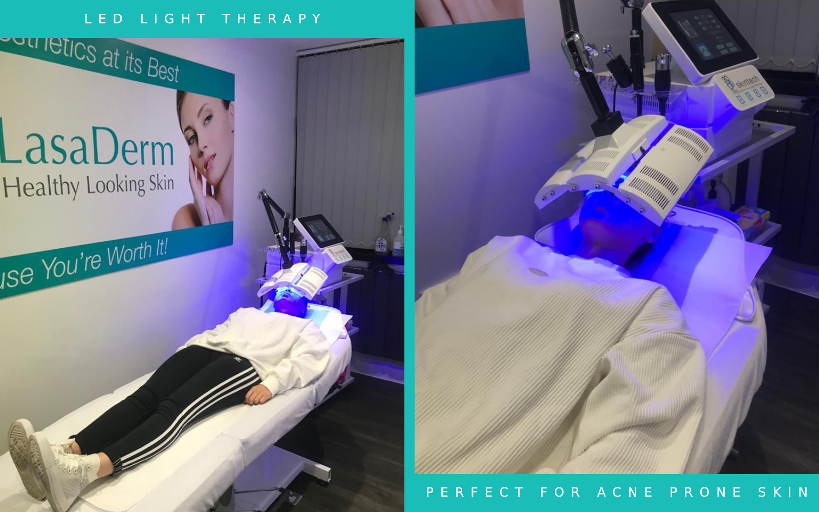 Before and After LED Light Therapy