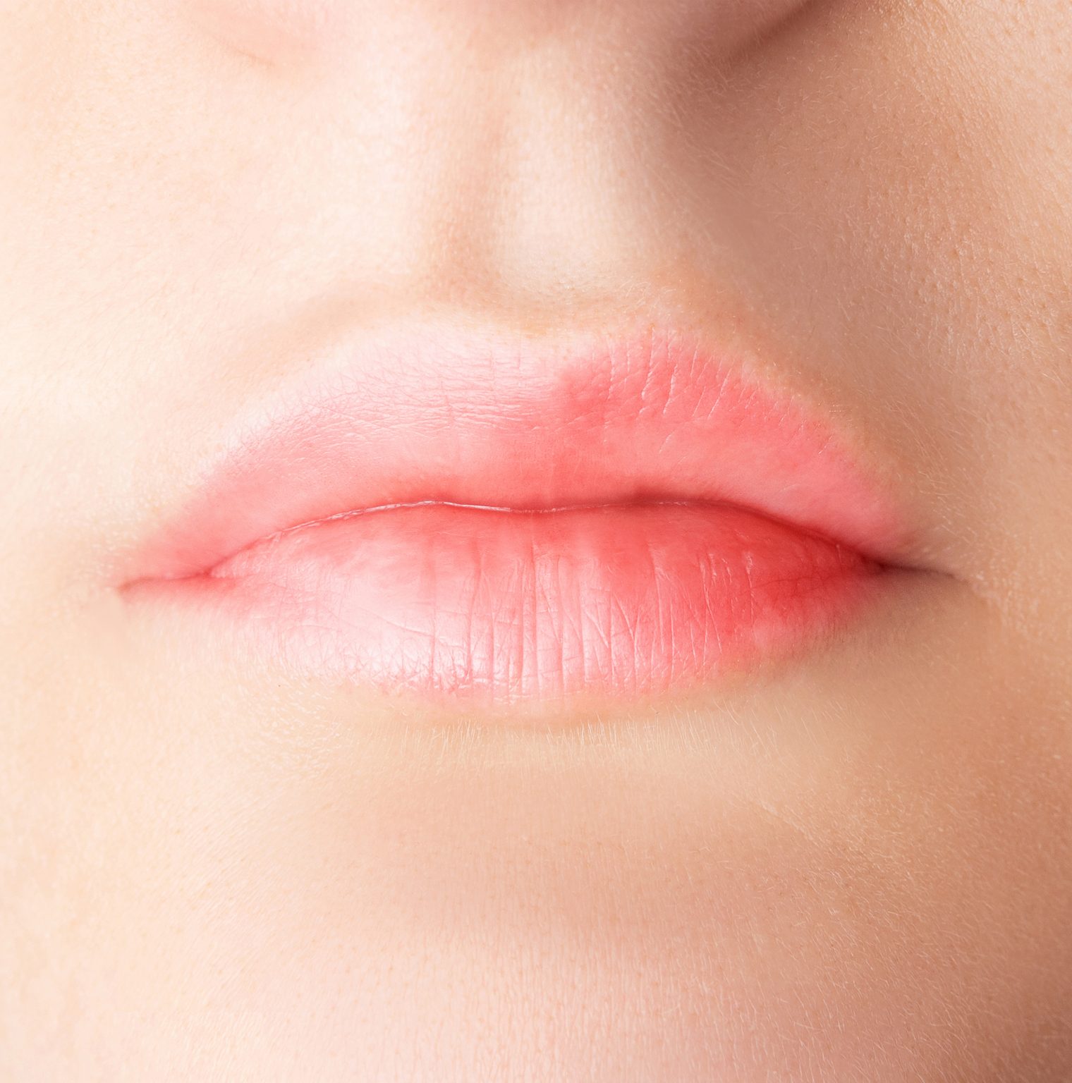 Teosyal Kiss Lip Filler Success Story LasaDerm