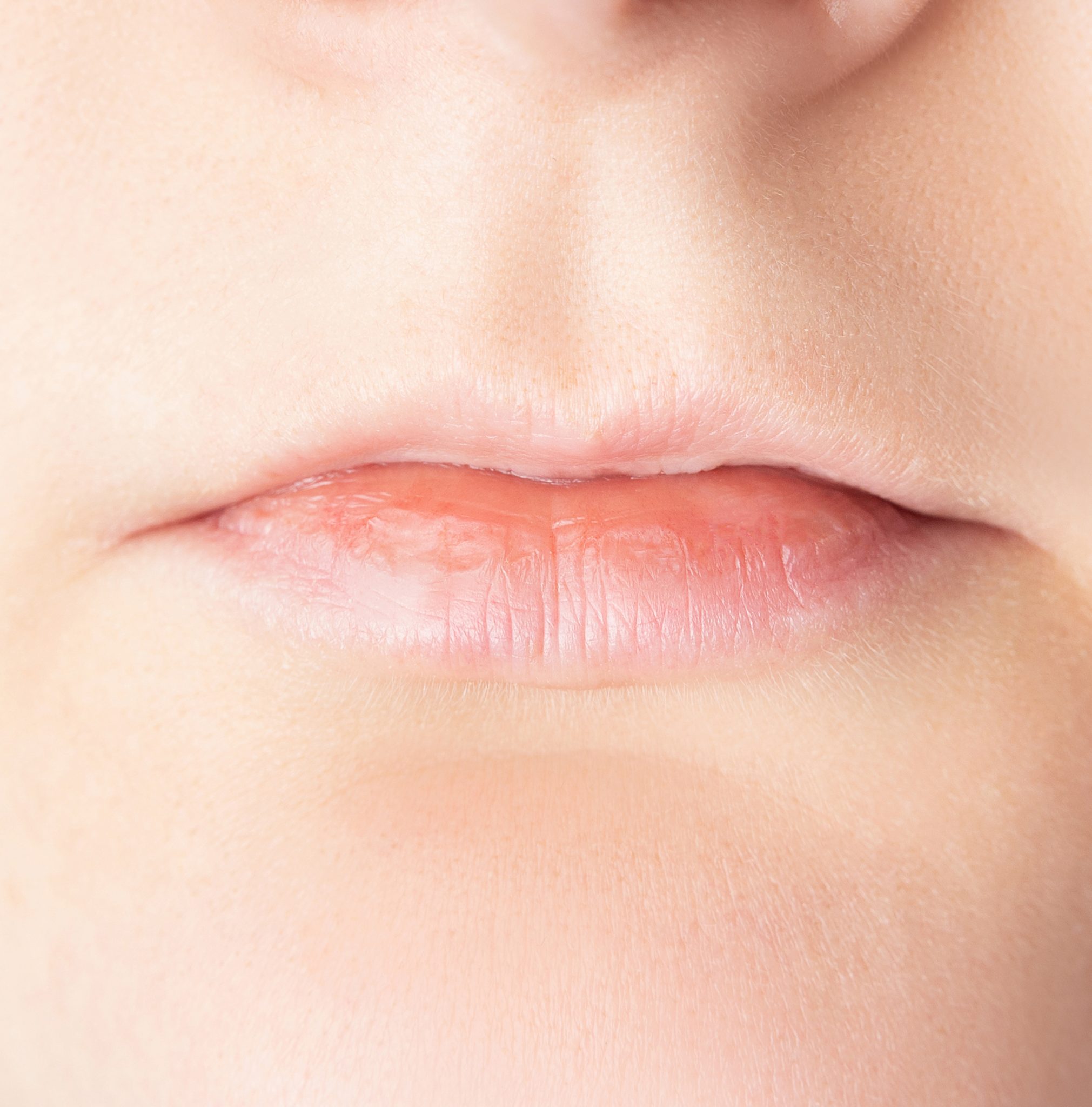 Teosyal Kiss Lip Filler Success Story LasaDerm