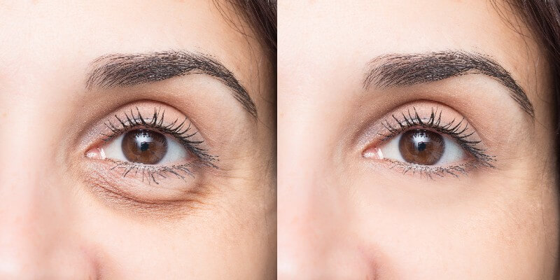 before and after eye treatment