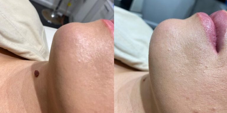 Before and After Skin Tag Removal
