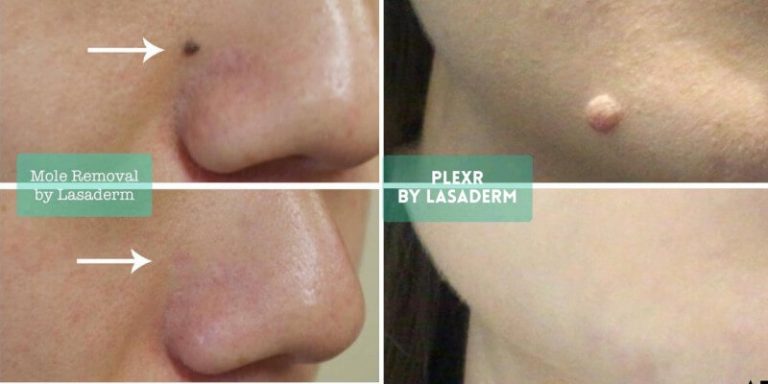 PlexR Lesion Removal