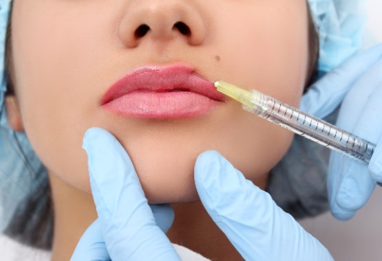 Injecting Lip Filler