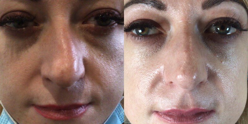 https://www.lasaderm.co.uk/2022/04/non-surgical-rhinoplasty-with-dermal-filler