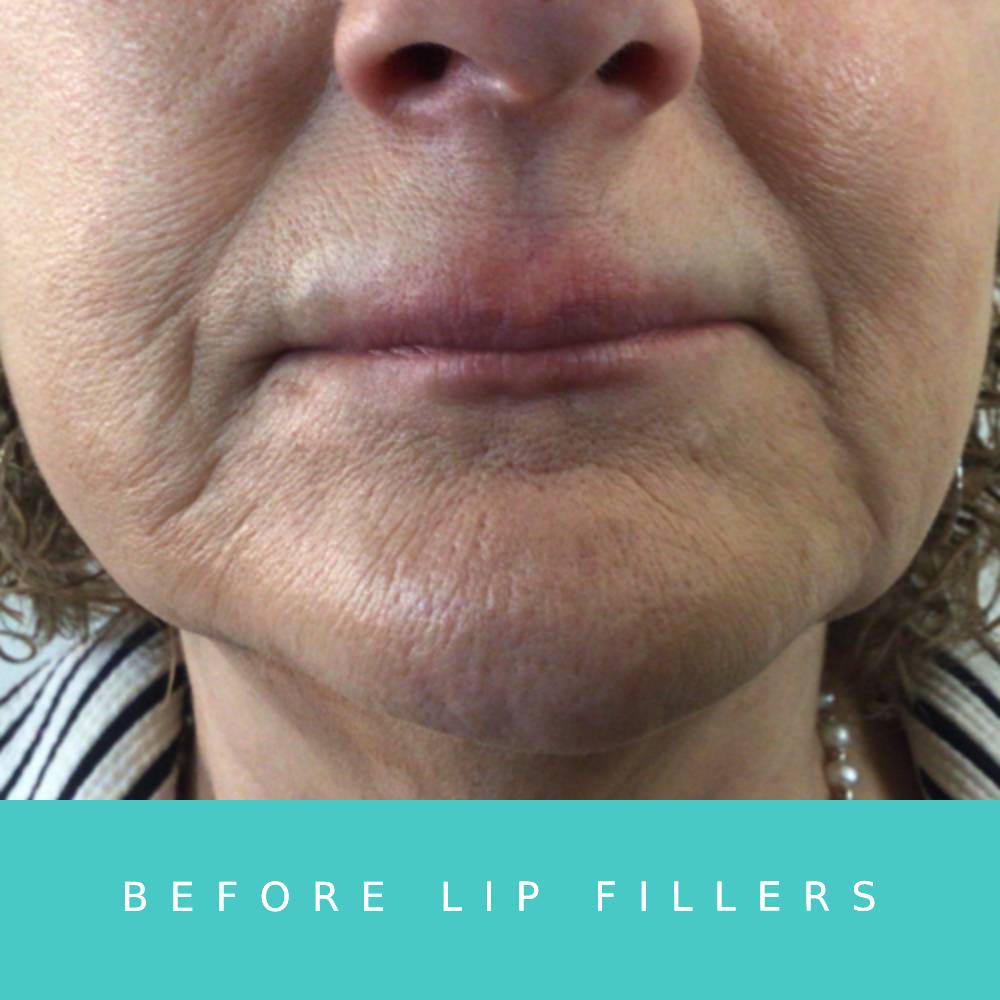 Lip Enhancement Success Story LasaDerm