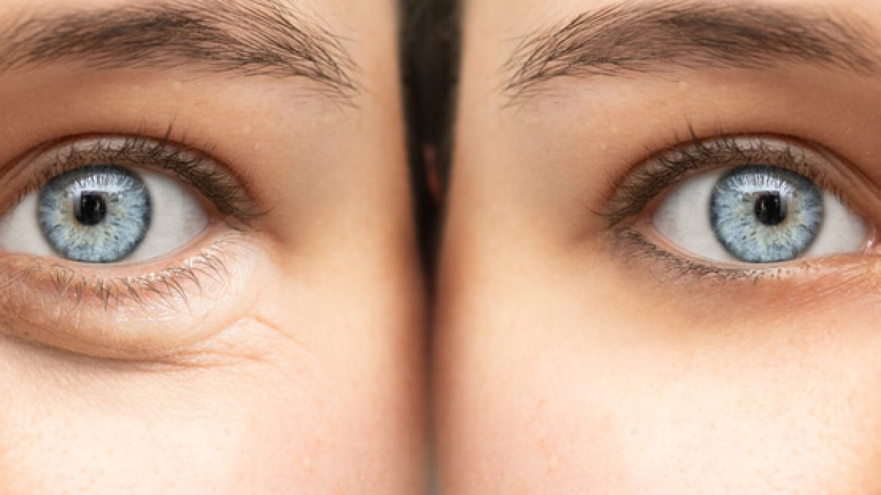 Aggregate 75+ bags under eyes from alcohol latest in.cdgdbentre