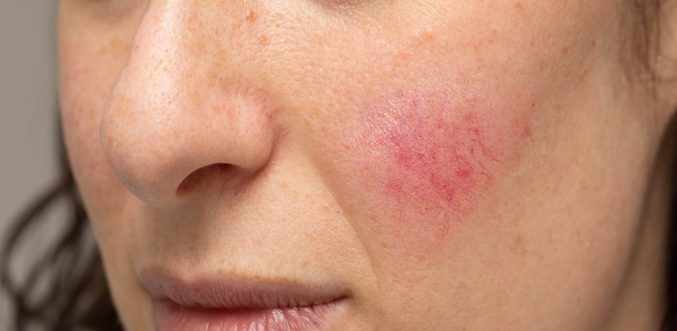 Mild Rosacea On Cheek