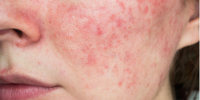 Rosacea On Cheeks