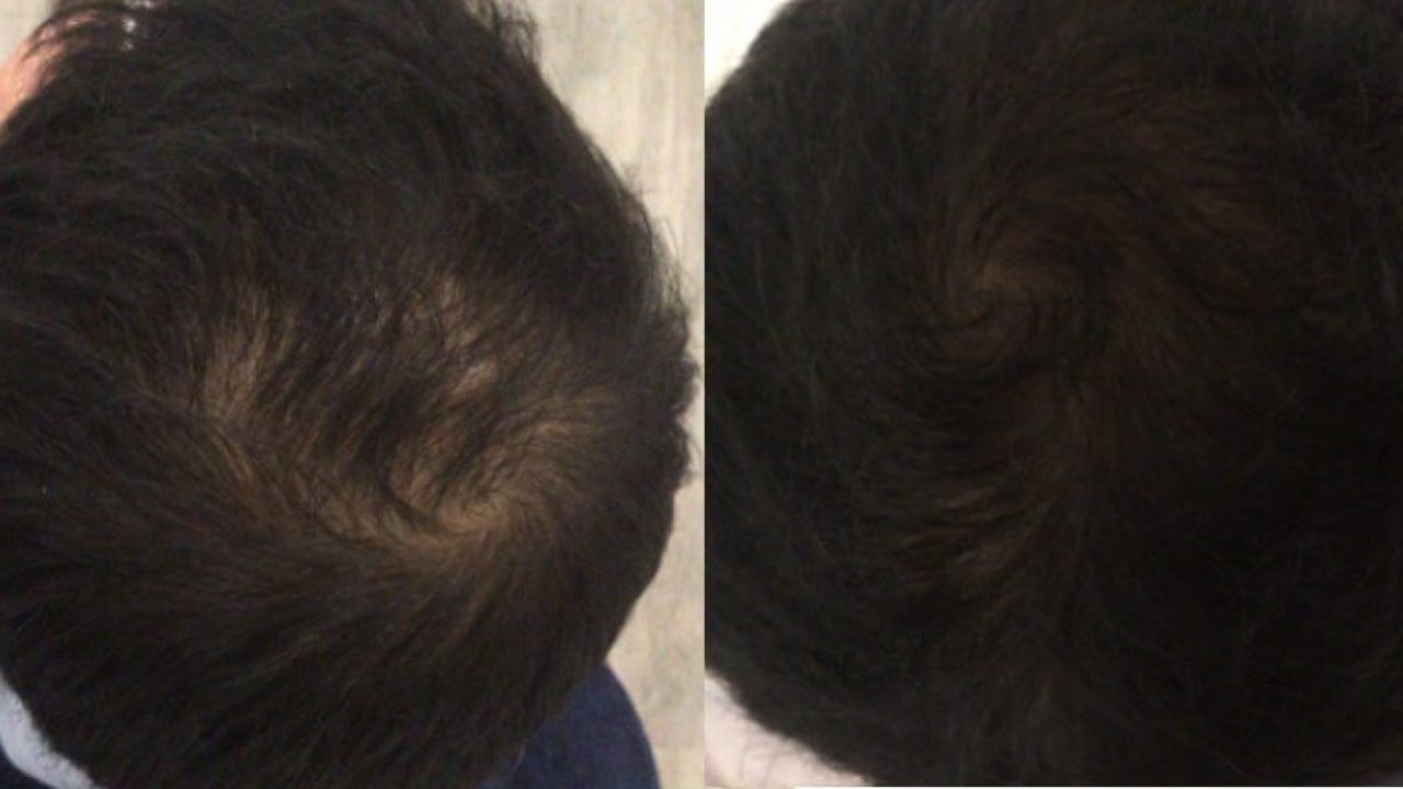 Maytham's PRP Treatment For Hair Loss - LasaDerm Maytham's PRP Treatment For Hair Loss - LasaDerm