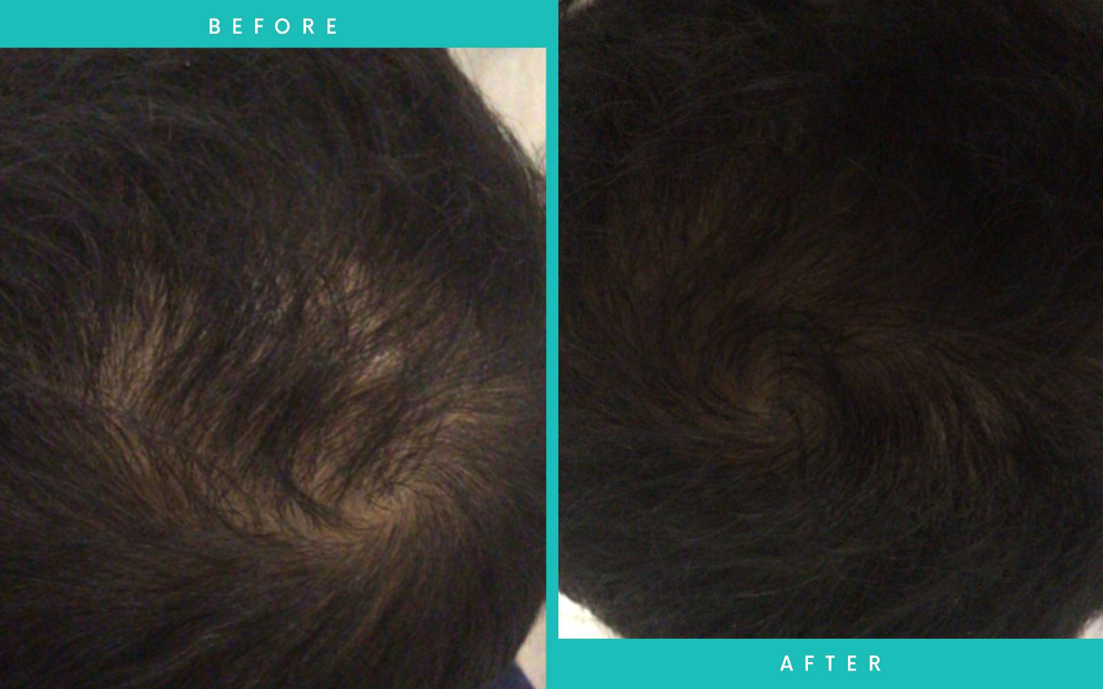 Before and After PRP Therapy