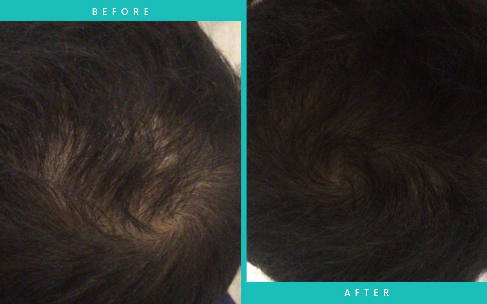 Maytham's PRP Treatment For Hair Loss - LasaDerm Maytham's PRP Treatment For Hair Loss - LasaDerm