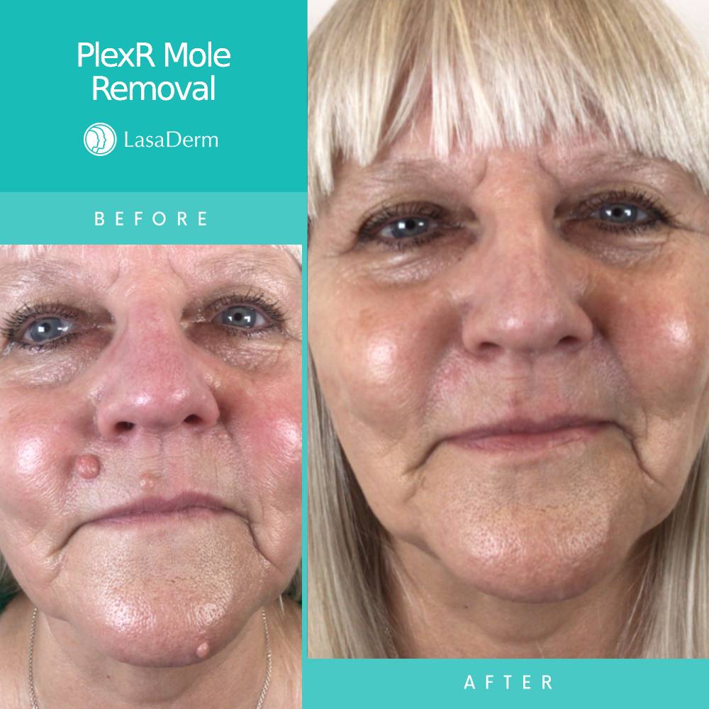 Facial Mole Removal Using PlexR LasaDerm