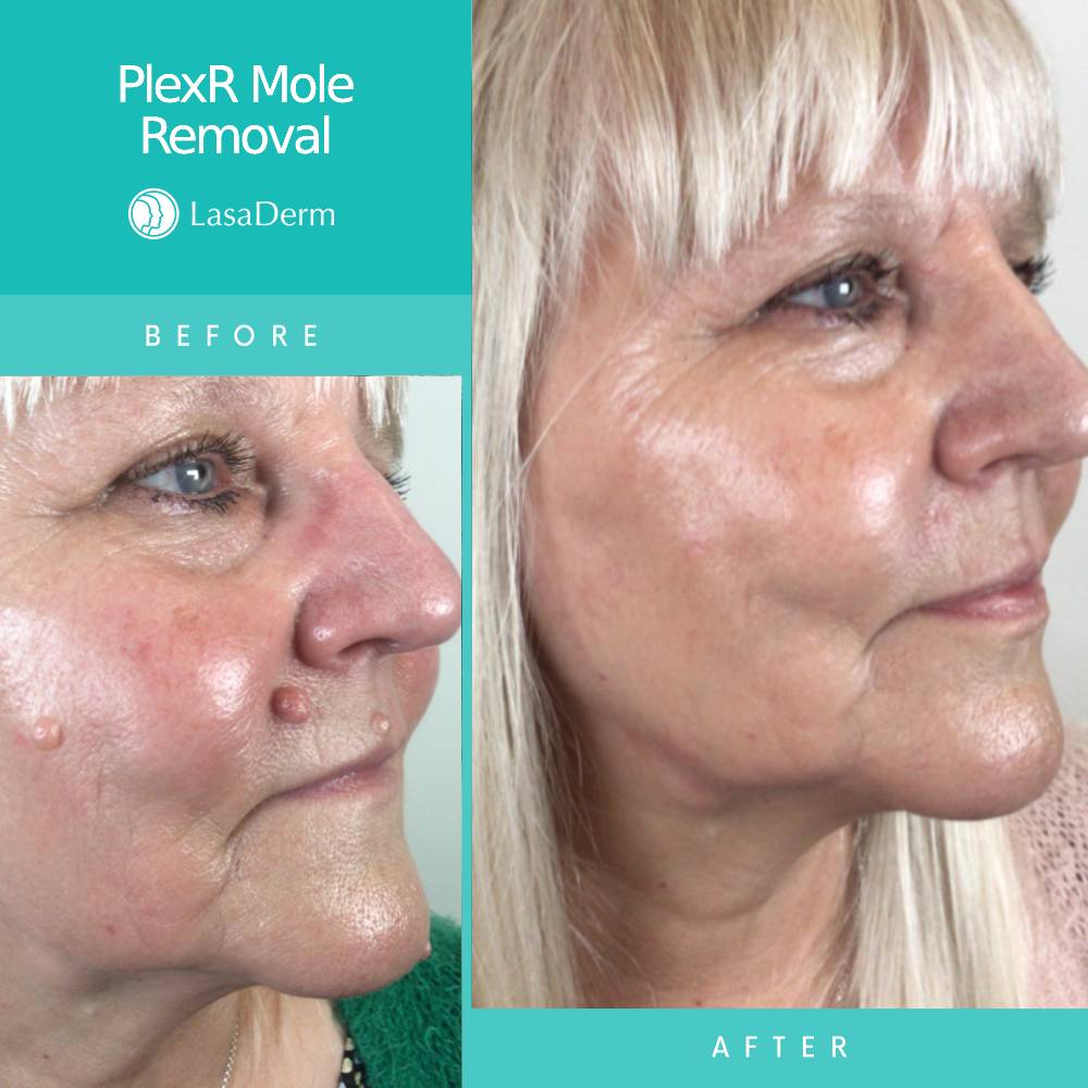 Facial Mole Removal Using PlexR LasaDerm