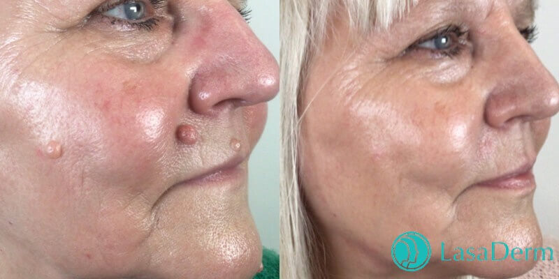 mole removal before and after