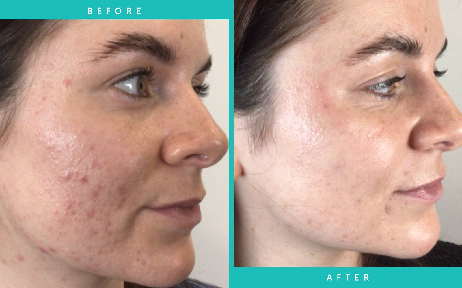 Acne Treatment Before and After