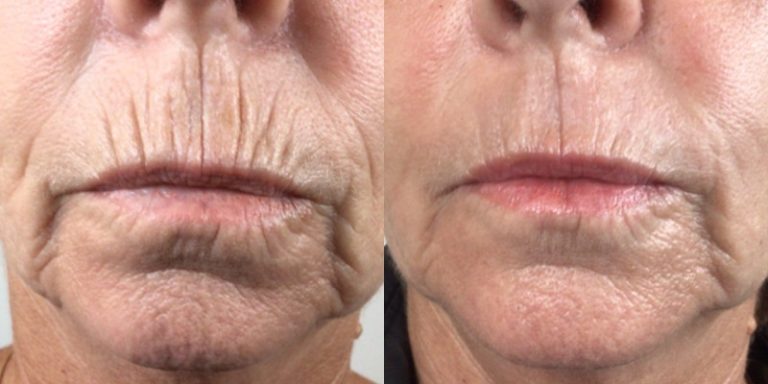 PlexR® Lip Line Reduction