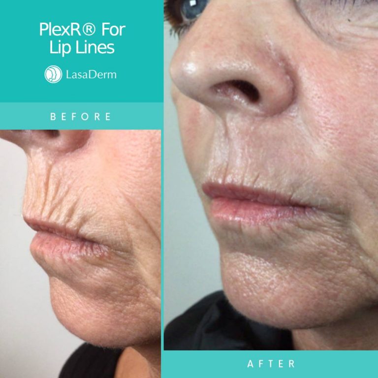 PlexR® For Lip Lines LasaDerm