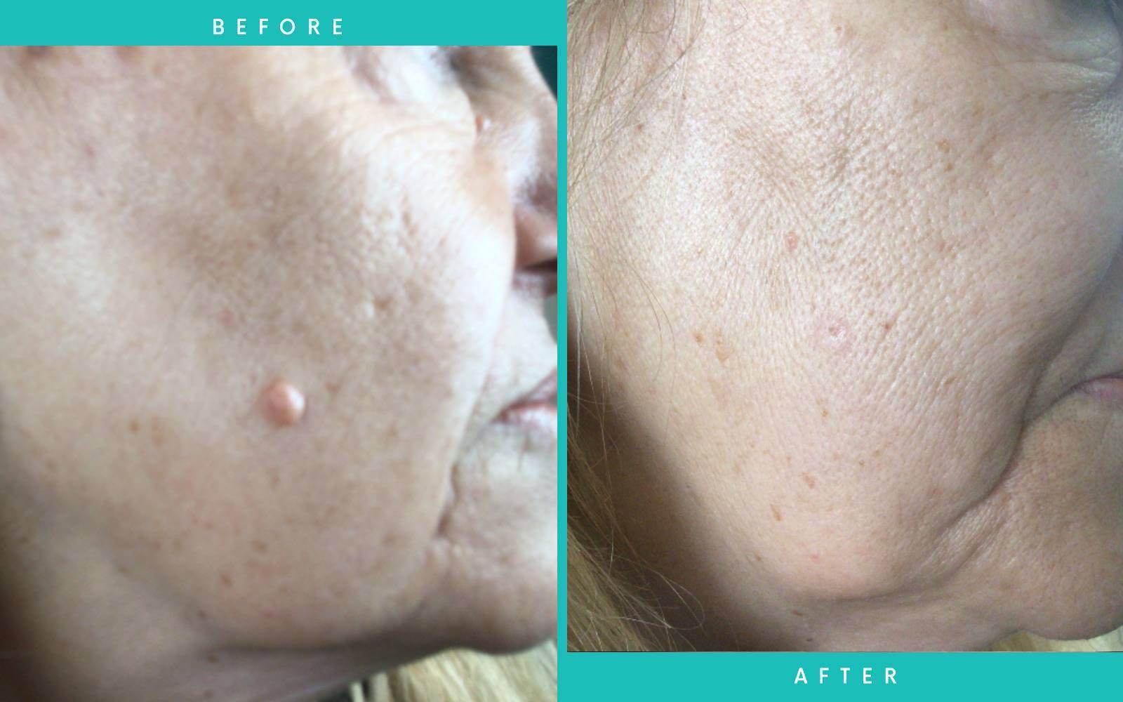 PlexR Mole Removal Before and After