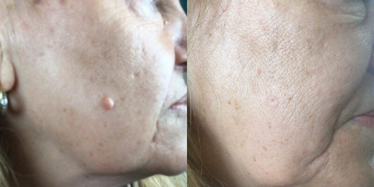 Geraldine’s PlexR® Mole Removal