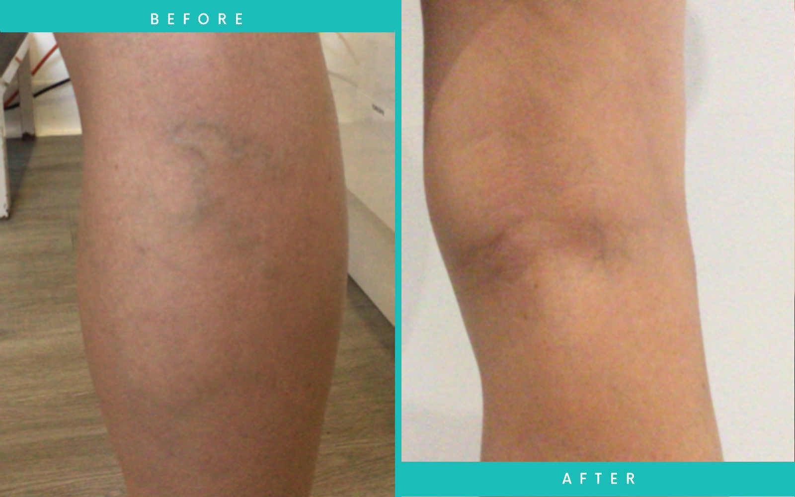 Foam Sclerotherapy Before And After