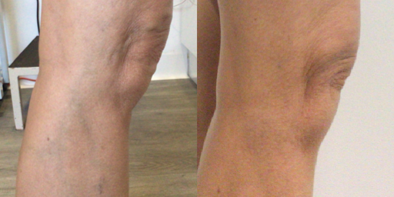 https://www.lasaderm.co.uk/2023/04/susans-foam-sclerotherapy