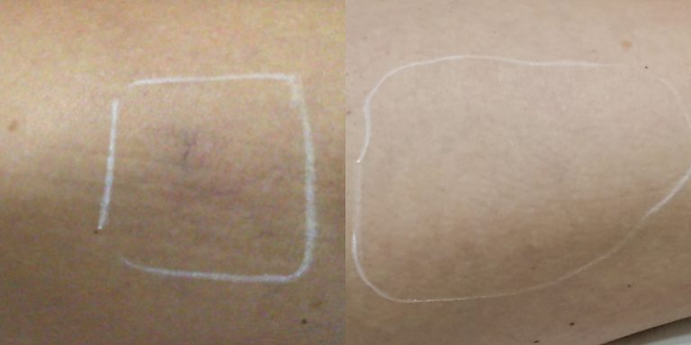 Thread Vein Before After