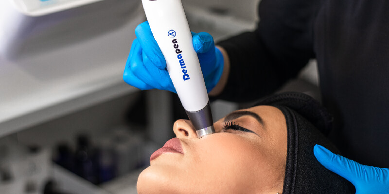 Microneedling Treatment