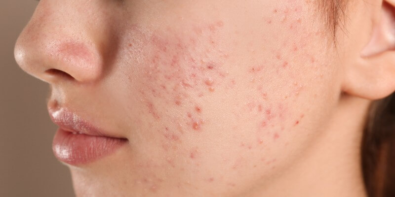 Acne Breakout On Cheeks