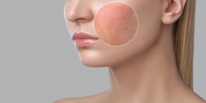 close up of rosacea on skin