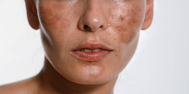 Hyperpigmentation On Skin