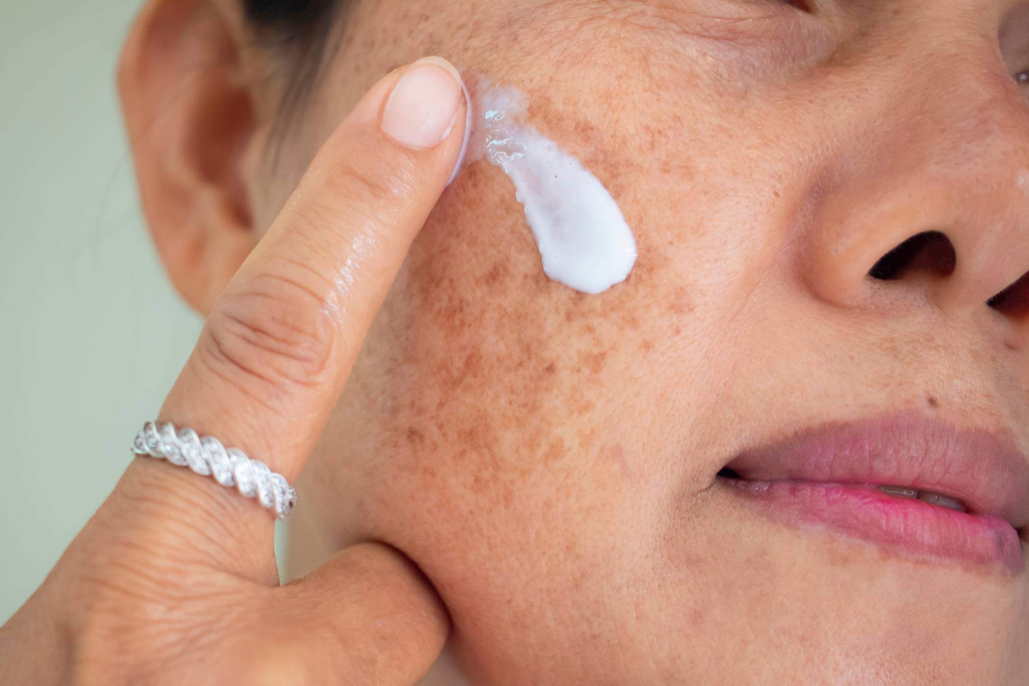 Our Guide On How To Get Rid Of Hyperpigmentation