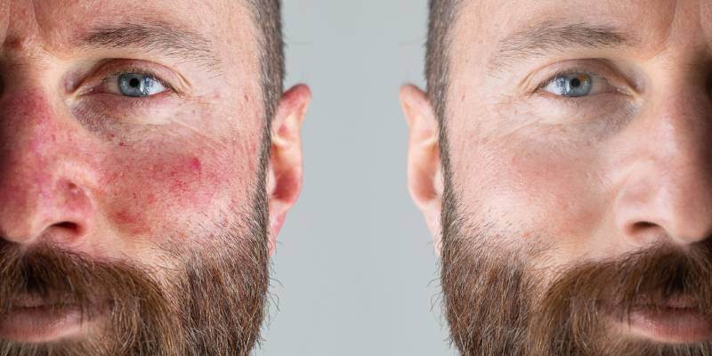 Man with and without rosacea