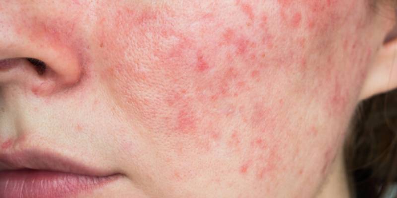 Rosacea On Cheeks
