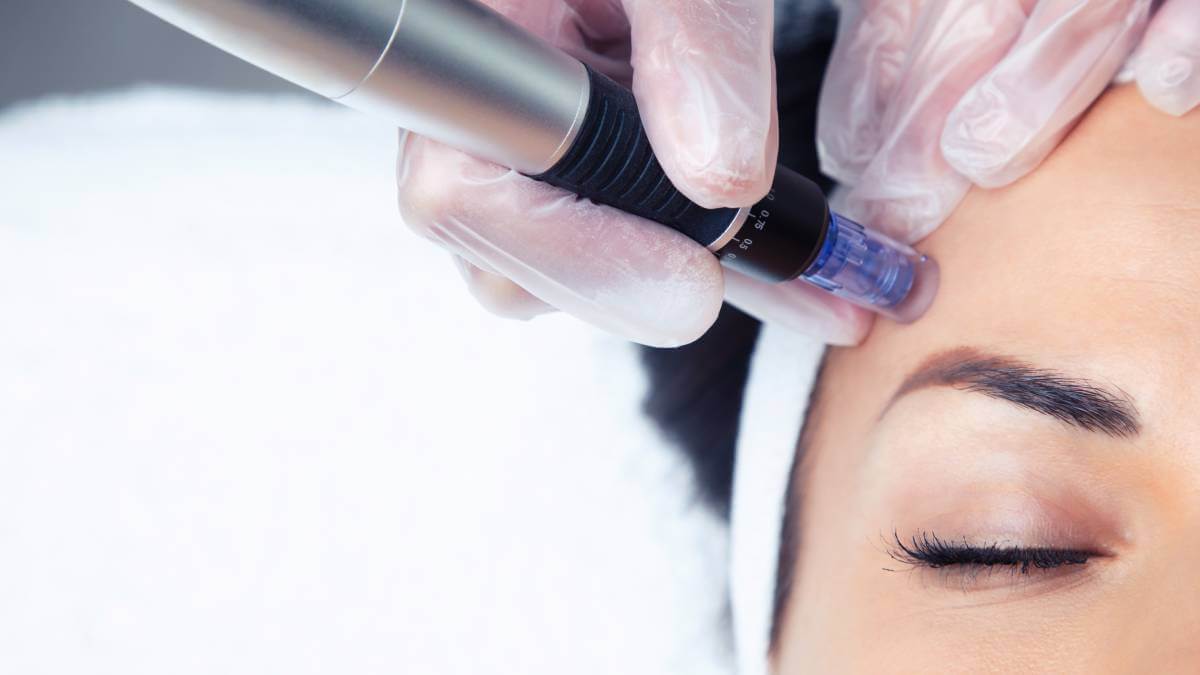 A picture of treatment on the forehead