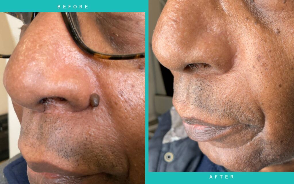 Plexr Mole Removal Results