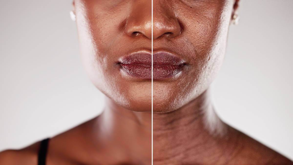 Before and after microdermabrasion